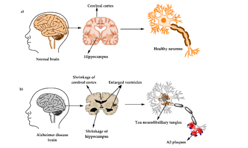 Alfa Chemistry Materials Donepezil - Application in The Treatment of Alzheimer'S Disease