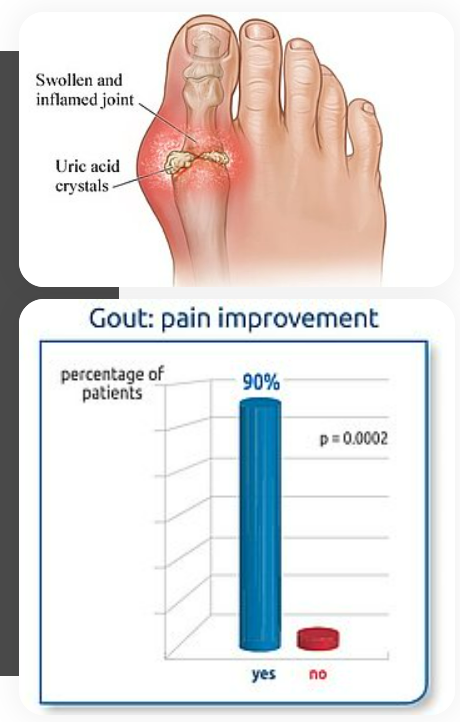 BioXtract ARANTAL - Observational Study of Gout Attack